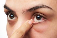 Buang Angin Bikin Mata Merah, Apakah Benar?