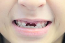 Waspada! Ini Bahayanya jika Gigi Ompong Dibiarkan Terlalu Lama